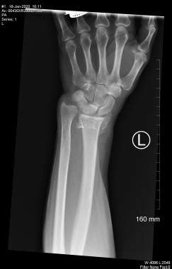 Carpal Bone Fracture