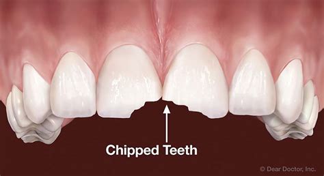 Cracked Teeth | The Office of Dr. Brian Choi & Dr. John Sudick ...