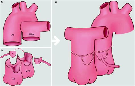 Arterial Switch Operation for Transposition of the Great Arteries ...