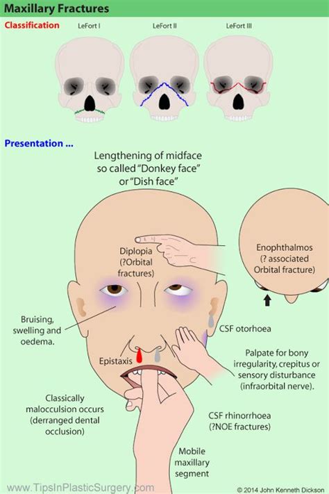 Pin on fractures