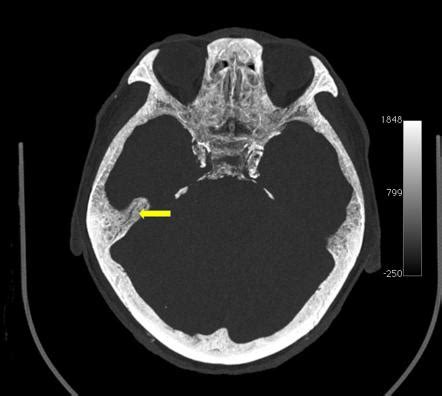 Mastoïd fractuur