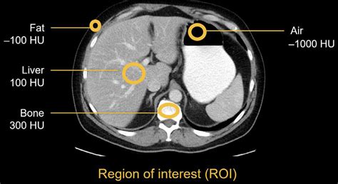 Abdominal CT: Attenuation • LITFL • Radiology library