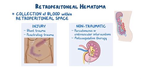 Retroperitoneal Bleed