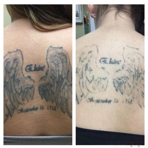 pico laser tattoo removal before and after - satombaroegner-99