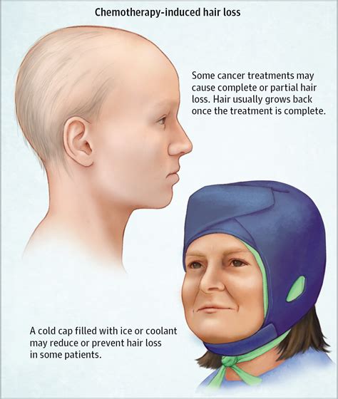 Chemotherapy-Induced Hair Loss (Alopecia) | Oncology | JAMA Oncology | JAMA Network