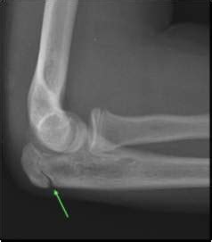 Differential Diagnosis - Elbow and Forearm