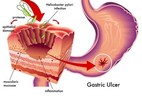 Gastrolact® and Helicobacter pylori (H. pylori) infection | LV Pharm