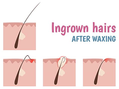 Basic Tips To Prevent Ingrown Hair - Boldsky.com