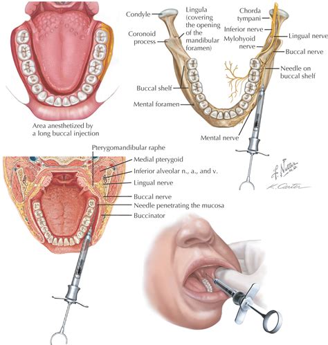 21: Intraoral Injections | Pocket Dentistry