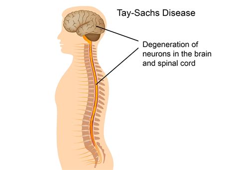 What is Tay-Sachs Disease? – Jewish Disease DNA