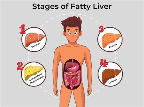 Fatty Liver Types, Symptoms, Stages, And Treatment, 58% OFF