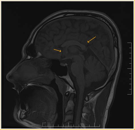 Agenesis of Anterior Corpus Callosum-Rare Finding - Sumer's Radiology Blog