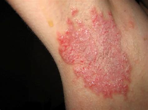 Underarm Rash (Itchy, Painful) - Pictures, Causes, Treatment