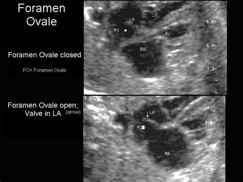 Foramen Ovale