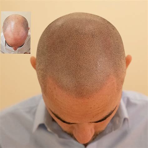 The Best Scalp Micropigmentation Results 2 - Scalp Micro USA