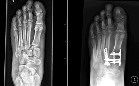 www.lisfranc.ca - Lisfranc Fracture / Injury Blog