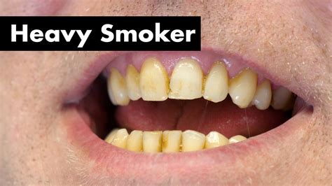 Cleaning Smoker's Teeth with Heavy Stain | Teeth Cleaning - Dental Clinic