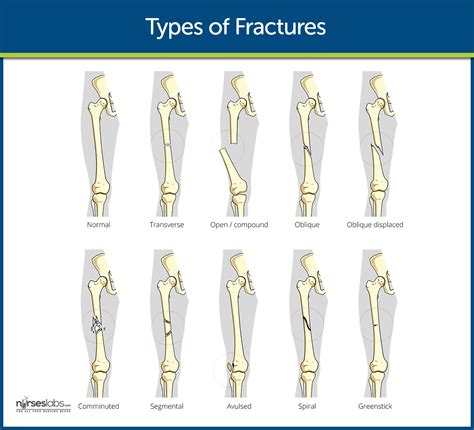 Fracture Nursing Care Management: Study Guide