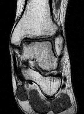 Osteochondral lesion of medial talar dome. | Download Scientific Diagram