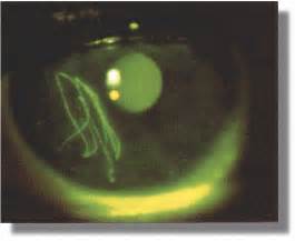 Doctors Gates: Corneal Abrasion:What to do and What not to do!