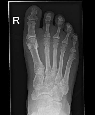 Xray Of Foot Stress Fracture