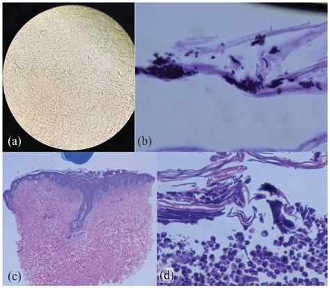 Cutaneous candidiasis mimicking acute generalized exanthematous ...