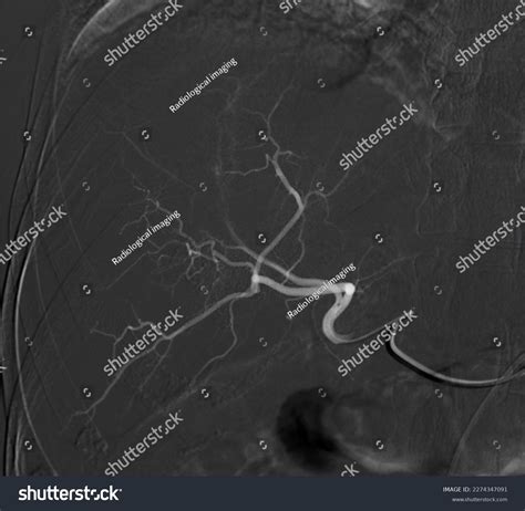 Imaging Tace Chemoembolization Procedure That Allows Stock Illustration 2274347091 | Shutterstock