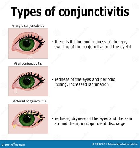 Conjunctivitis. Redness And Inflammation Of The Eye. Vessels. Eye Drops ...