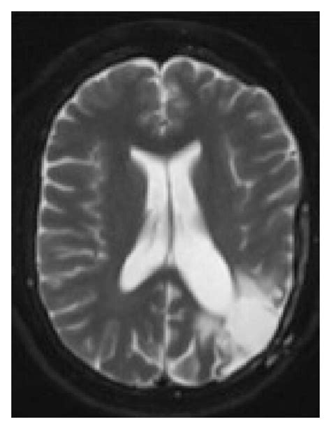 (a) Axial CT status after craniectomy, demonstrating partial clot... | Download Scientific Diagram