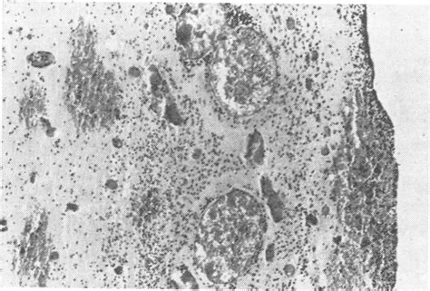 Old cortical laminar necrosis with neuronal loss, gliosis, and foam... | Download Scientific Diagram