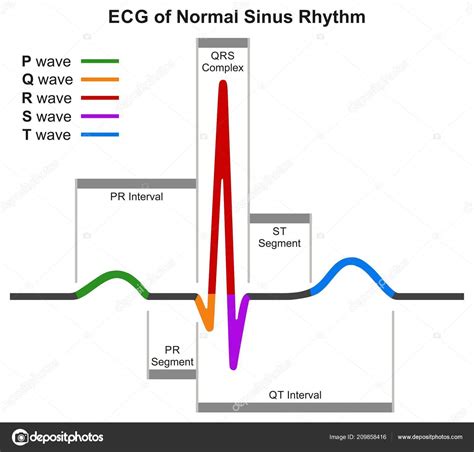 Ecg Ritmo Sinusal Normal Diagrama Infográfico Que Muestra Onda Cardiaca Stock Vector by ©udaix ...