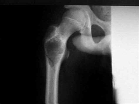 Simple Bone Cyst (Unicameral) : Wheeless' Textbook of Orthopaedics