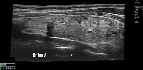 Ultrasound imaging: Panoramic-views-multinodular-goiter