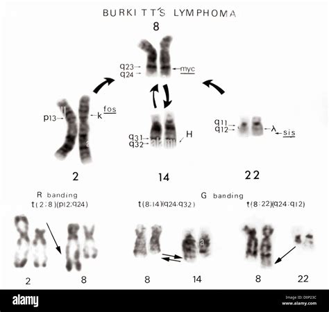 A partial karyotype showing translocations involving Chromosome 8 Chromosomes 2 14 22 in Burkitt ...