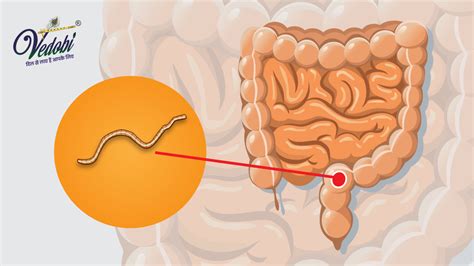 Vedobi - What are Intestinal Worms? Know its Causes, Symptoms and Home remedies