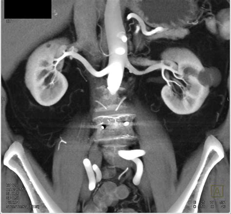 Bosniak Klassifikation : Ultrasound of the urinary tract - Renal cysts ...