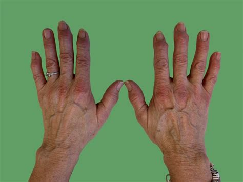 Osteoarthritis in the Hand – Aberdeen Virtual Hand Clinic