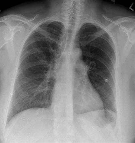 Pulmonary Thromboembolism – Undergraduate Diagnostic Imaging Fundamentals