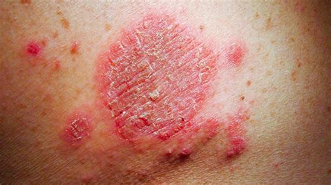 Eczema: Symptoms, Treatment, Causes, More