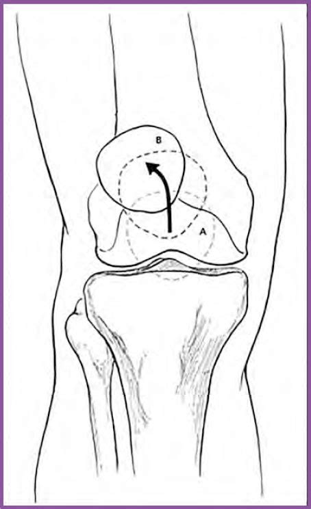 Patellofemoral Disorders | Musculoskeletal Key