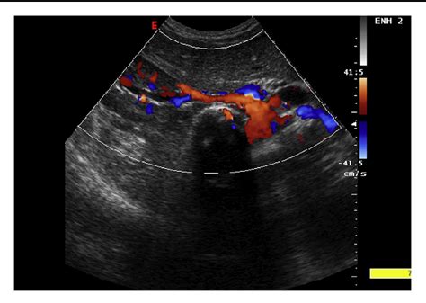 [PDF] Doppler ultrasound and renal artery stenosis: An overview. | Semantic Scholar