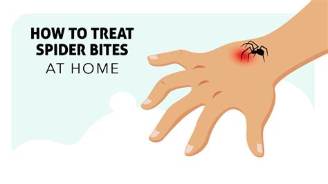 How to Treat Spider Bites at Home - Insight Pest Control