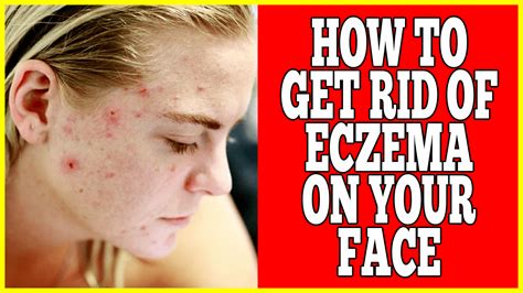 How To Get Rid OF Eczema On Face - Clinton Conley