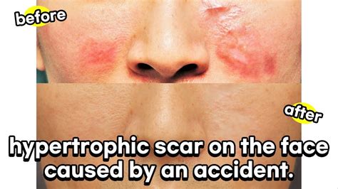 hypertrophic scar on the face caused by an accident. It's been treated cleanly! - YouTube