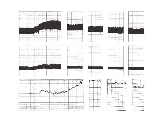 Representative computer scan of a chart record before and after i.v ...