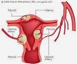 Medical Treatment Pictures-for Better Understanding: Abdominal myomectomy: Before & After