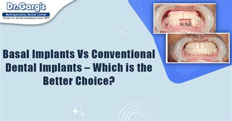 Basal Implants Vs Conventional Dental Implants – Which is the Better Choice?