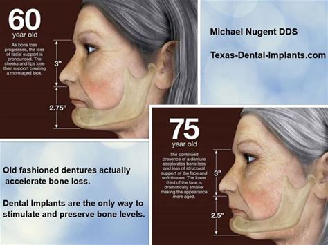 Jaw bone loss – Michael Nugent DDS