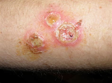 Staph Infection After A Burn – Northeast School of Botanical Medicine