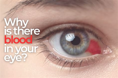 Subconjunctival Hemorrhages: Why Is There Blood In My Eye? - EZOnTheEyes